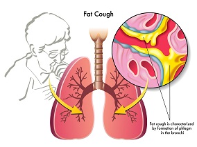 成人支气管扩张:吸入性抗菌药的有效性和安全性知多少