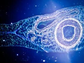 脑梗死病情刚平稳 死神又向他招手