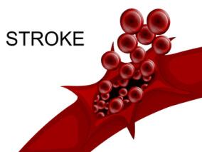 55岁男性脑梗死 白天正常呼吸每到夜间即呼吸停止