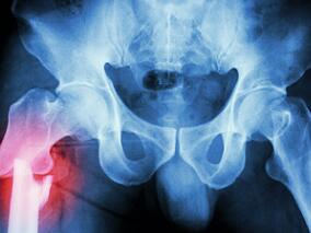 髋部骨折风险随PPI剂量无限升高?