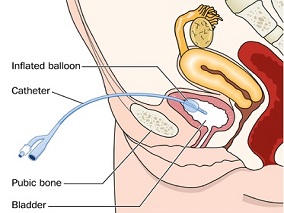 罕见的2例原发性尿道恶性黑色素瘤