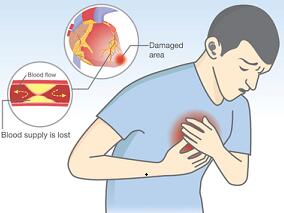 东亚急性冠状动脉综合征患者：氯吡格雷or替卡格雷or 普拉格雷更适合？