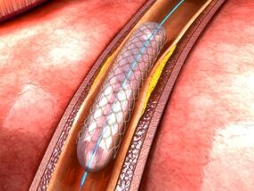 药物洗脱支架植入后 DAPT仅需1个月？