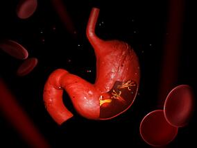 可手术切除胃食管腺癌患者 围手术期化疗化疗联合拉帕替尼可行