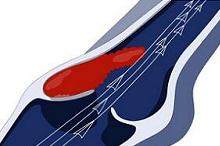 降低危重病患者静脉血栓栓塞风险 出院后长期DOAC有效有益