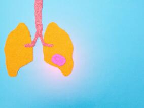 晚期非鳞NSCLC一线治疗 帕博利珠单抗联合化疗效力如何?