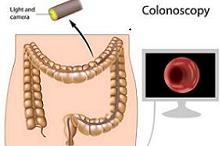 补充海洋ω-3脂肪酸不能降低结直肠癌前病变的风险