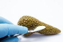 晚期胰腺癌:白蛋白结合型紫杉醇+吉西他滨+顺铂缓解率高