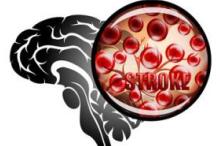 教科书式病例!1例典型大动脉粥样硬化性脑梗死