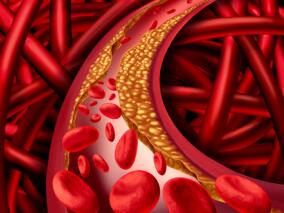 脑血管慢性闭塞 血管再通治疗需要考量哪些因素?