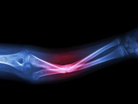 糖皮质激素诱导的骨折患者 特立帕肽和地舒单抗或优于口服双膦酸盐