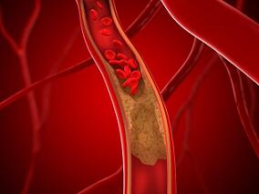 非布司他能否延迟无症状高尿酸血症患者颈动脉粥样硬化的进展?
