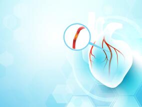 接受PCI的ACS患者 短期普拉格雷或替格瑞洛vs长期DAPT