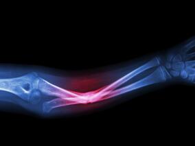 症状性膝骨关节炎伴骨髓病变患者 唑来膦酸能用吗？