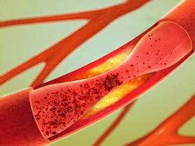 将LDL-C“管起来” 药剂师干预不容小觑