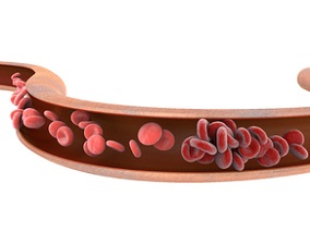 急性门静脉血栓形成:介入治疗有效率加倍 代价是…