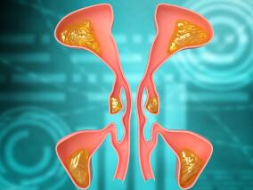 右鼻腔反复出血3年未重视 结果影像学提示鼻腔内有粉红色肿物
