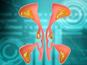 一患者鼻塞、头痛加重后 影像学检查提示筛窦区占位