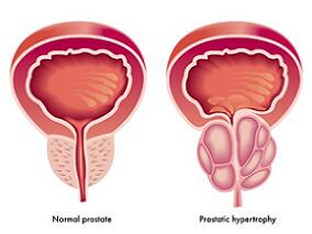前列腺癌合并心血管疾病患者：地加瑞克vs 亮丙瑞林 真实世界心血管结局揭晓