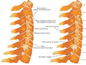 中年女性颈背部疼痛1年 除了颈椎病还患有…