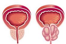 转移性去势抵抗前列腺癌：奥拉帕利治疗可显著延长生存期
