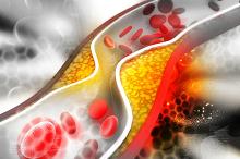 外周动脉疾病：紫杉醇涂层球囊和支架治疗不会增加死亡率