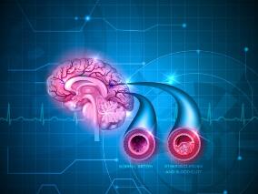 新冠疫情或延迟了急性卒中患者静脉溶栓的治疗