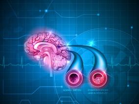 男子反复头痛伴呕吐以为是脑血管痉挛 治疗后却未见好转