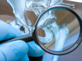 动态监测微小残留病变可准确预测多发性骨髓瘤患者预后