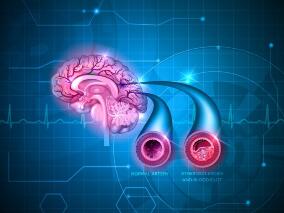 大妈突发言语不清、右侧肢体无力2个多月 治疗之路一波三折