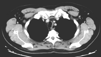 这例治疗难度大的上段食管癌 二次多学科讨论终于获得良好疗效
