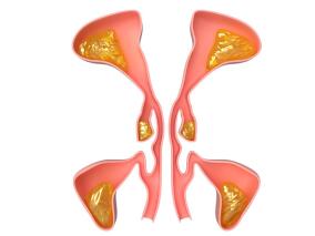 35岁男性鼻塞半年 哪里出了问题？