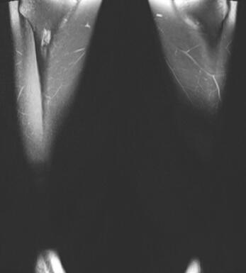 花季少女多饮多尿增重停经 MRI增强检查发现“垂体柄增粗”