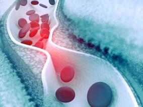 脑静脉血栓 直接口服抗凝剂vs华法林