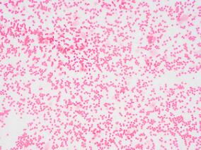 中年男子头晕、乏力1月余 原来是血液病