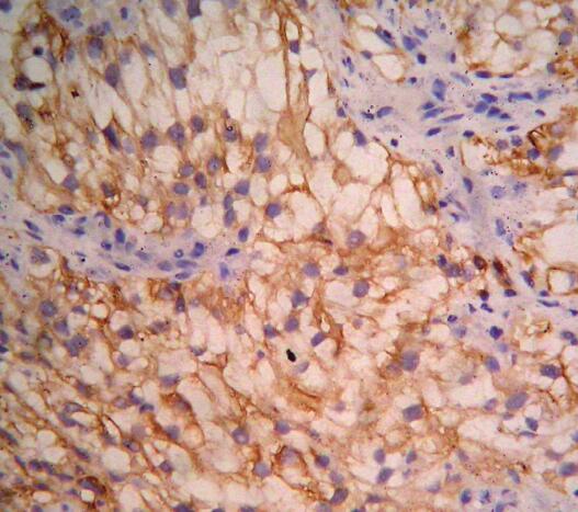 男子气短1个月 胸片提示左侧大量胸腔积液 诊断结果出乎意料