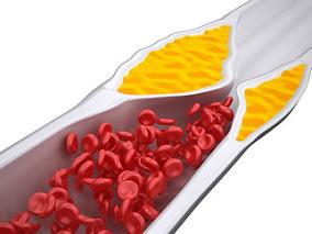 动脉粥样硬化性心血管疾病降脂 中强度他汀联合依折麦布vs高强度他汀单药