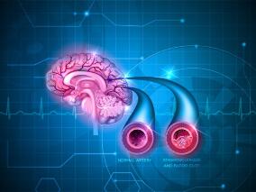 大血管闭塞脑卒中：替奈普酶vs阿替普酶