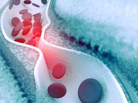 常规临床实践中溶栓：替奈普酶vs阿替普酶