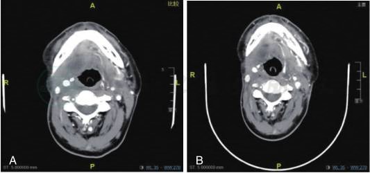 右舌根鳞状细胞癌术后放疗后复发病例的全程管理