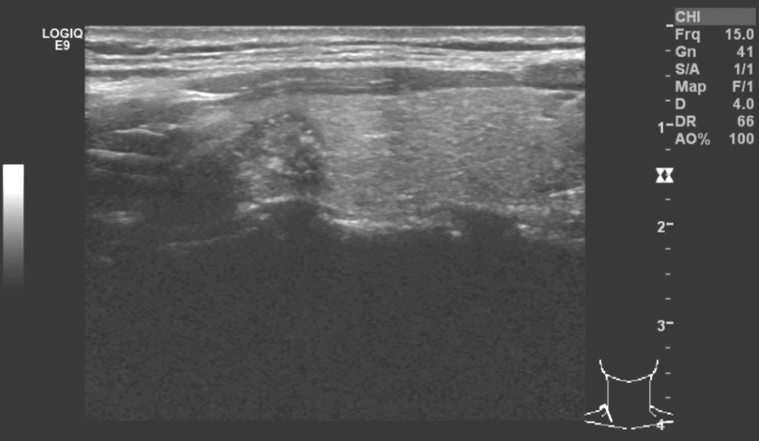 一例甲状腺乳头状癌右颈部淋巴结转移的诊治
