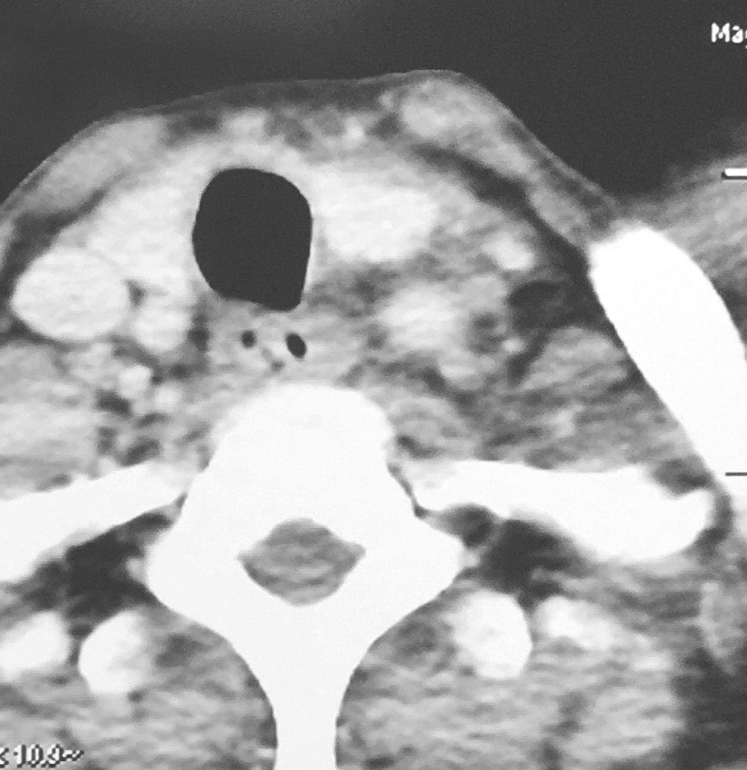 一例下咽癌双颈淋巴结转移行术前同步放化疗+根治手术的诊治解析