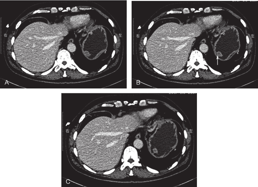 一例极低危胃双灶间质瘤诊治经验分享