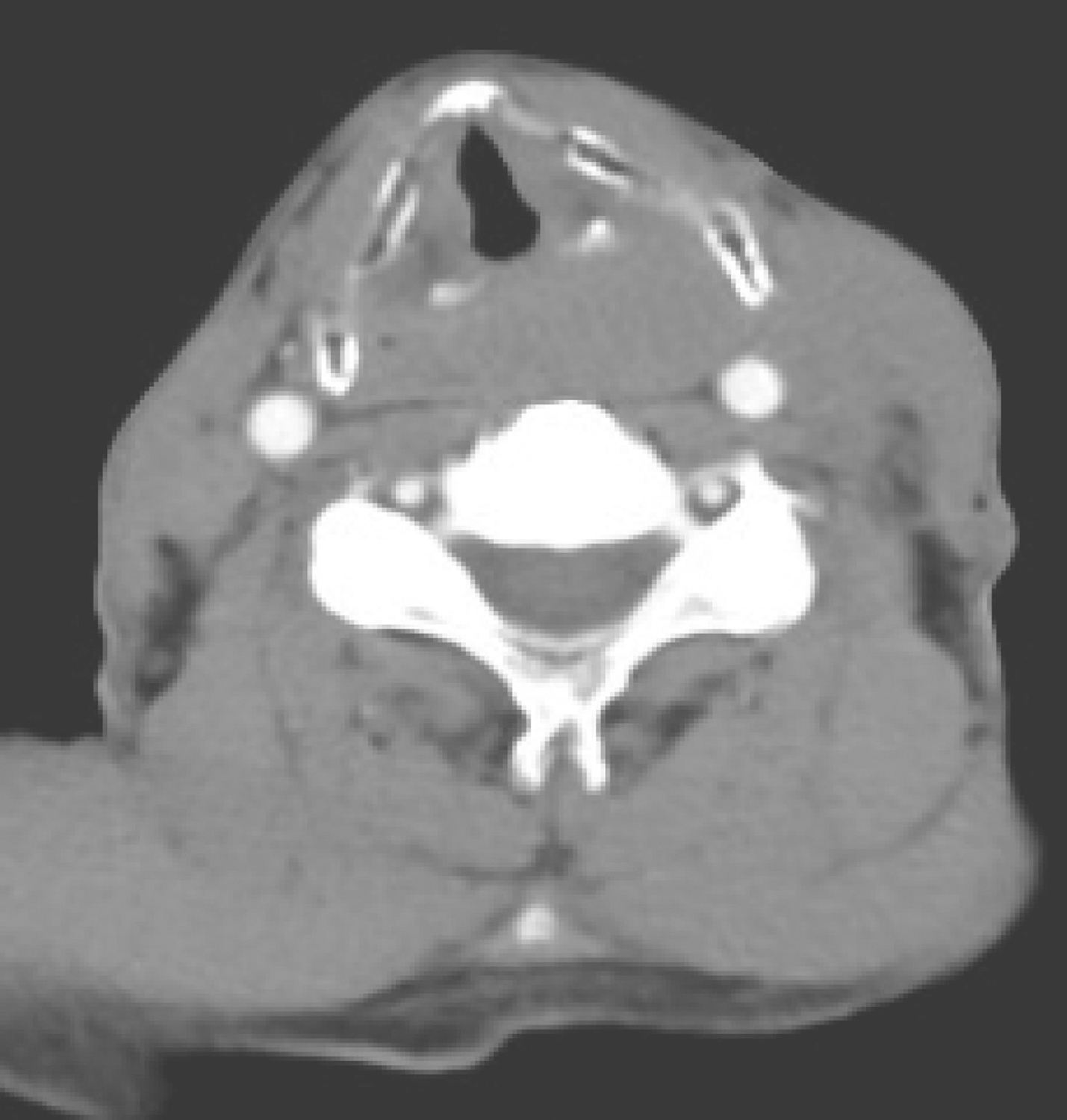 一例下咽癌左颈部淋巴结转移诊治经验分享