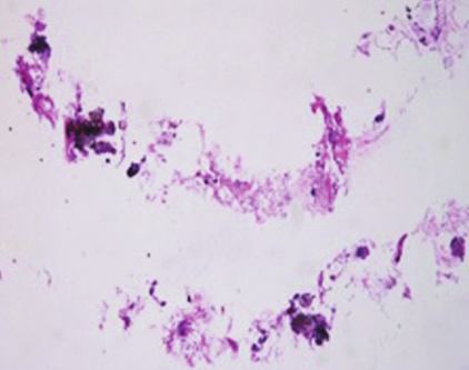 一例家族性肺泡微结石症诊治经验分享