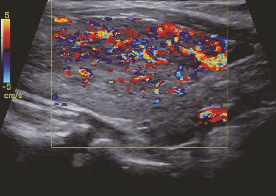 姜玉新、夏宇：甲状腺疾病的影像学诊断——超声