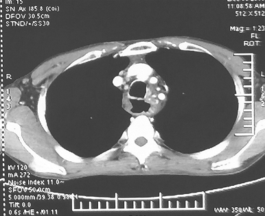 一例下咽癌合并食管癌的诊治经验分享