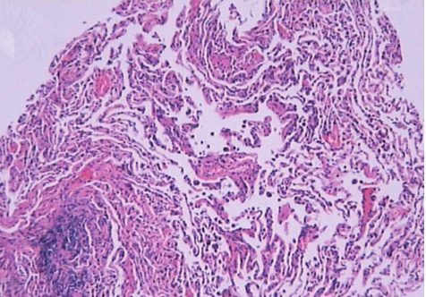 一例巨细胞间质性肺炎的诊治经验分享