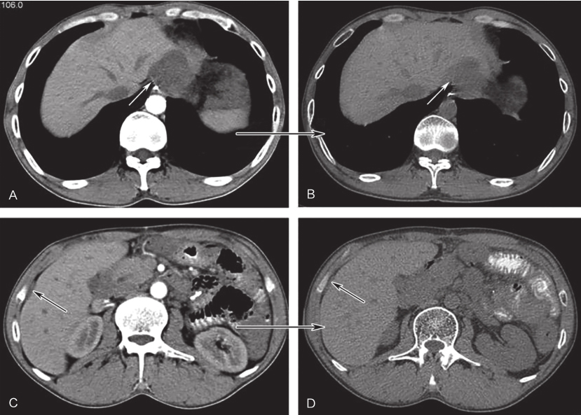 一例病情复杂的胃肠间质瘤的诊治经验分享