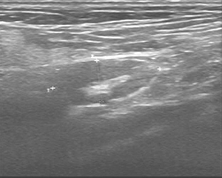 一例口咽侧壁鳞癌的根治性放疗经验分享